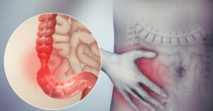 Най-добрия пробиотик за дебелото черво? Мнения, Топ 10 2 най добрия пробиотик за дебелото черво