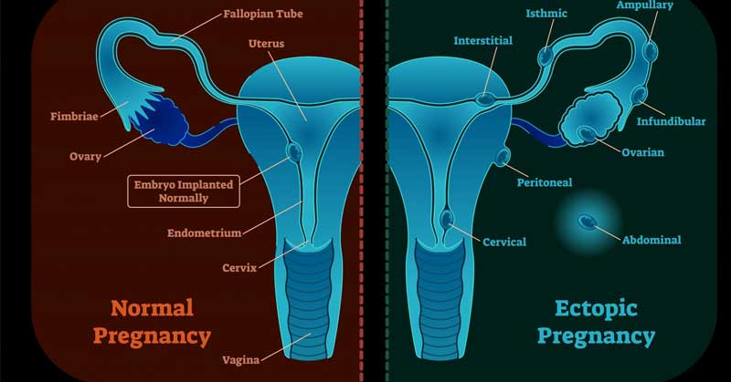 Възстановяване след извънматочна бременност. Усещане и ранни симптоми 10 Извънматочна бременност симптоми