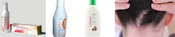 seboreen-dermatit-Seborrhoeic-dermatitis-glava-kosa-lice-04