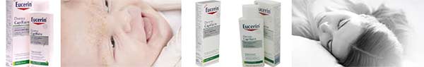 seboreen-dermatit-Seborrhoeic-dermatitis-glava-kosa-lice-07