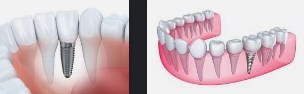 doctorbg.net---zybni-implanti-kak-rabotyat-i-za-kogo-sa-02