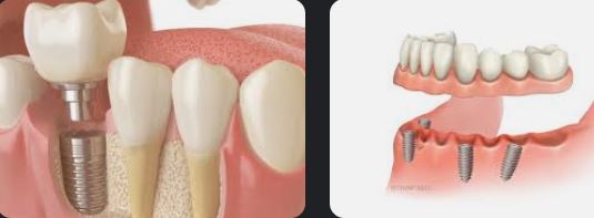 doctorbg.net---zybni-implanti-kak-rabotyat-i-za-kogo-sa-03