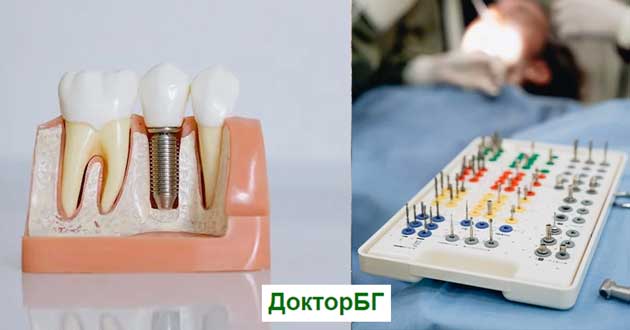 zybni-implanti-i-estetichna-stomatologia-01