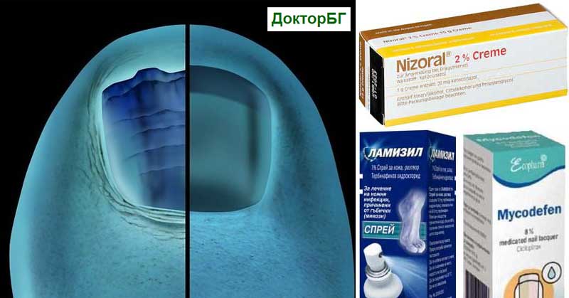 Кое е най-силното лекарство за гъбички по ноктите? От ветеринарната аптека - Антифлегмин. Какво немско лекарство за гъбички по ноктите? Спорил за хора и Миконафин. Орунгал крем.