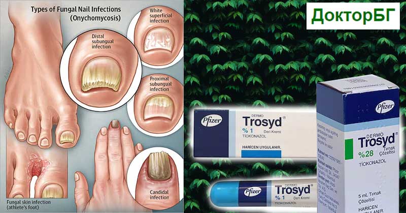 Тросид лак за гъбички по ноктите. Заместители и комбинации. Дерморест, Верутол