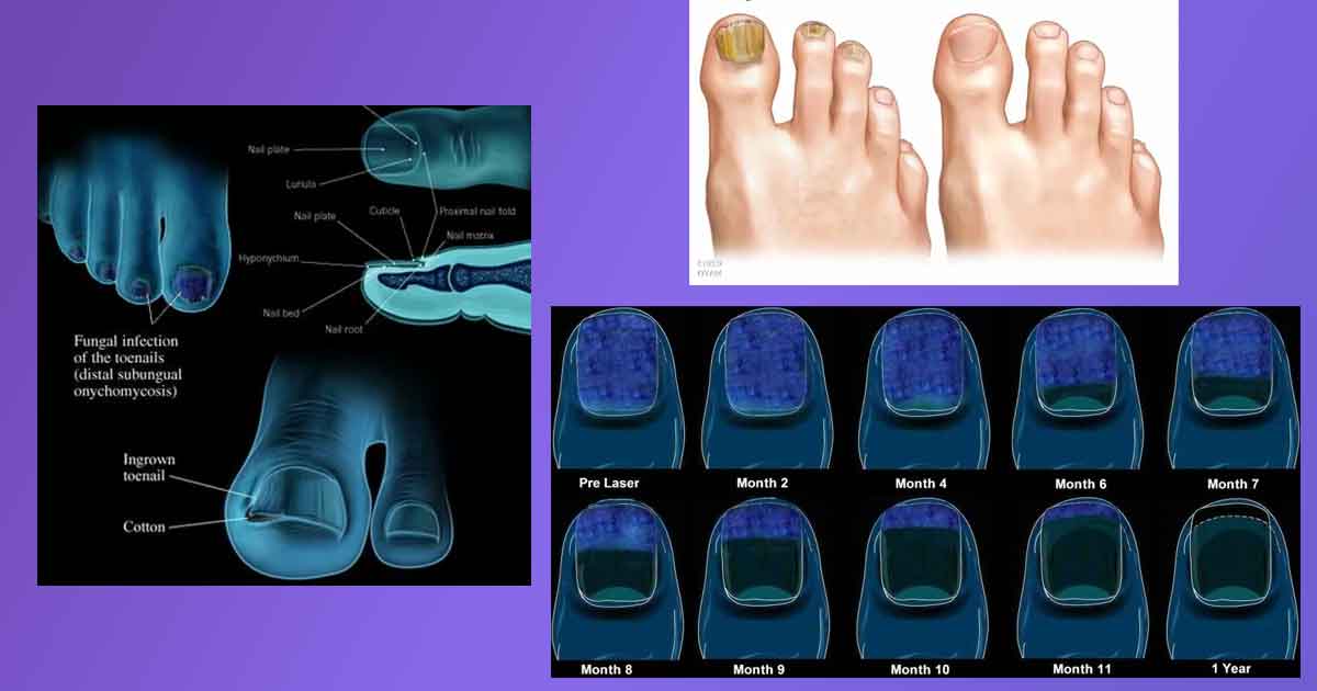 Как се отървах от гъбички по ноктите 1