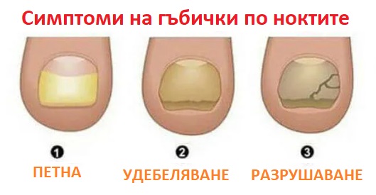 Лечение на гъбички по ноктите 01