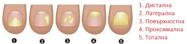 Лечение на гъбички по ноктите 02