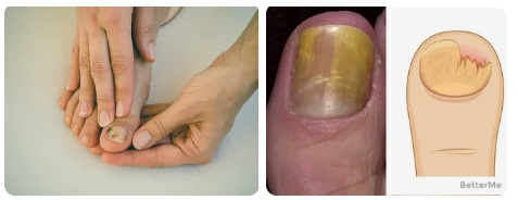 Мнения за Тросид лак и крем. Най-добра цена 4 Тросид гъбички нокти 02