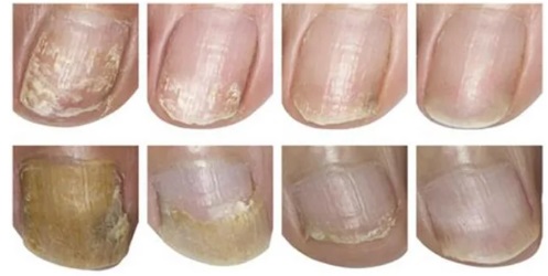 Гъбички по ноктите Екзодерил фунгитер лак за нокти мнения 02