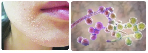 Ламизил крем гъбички 01