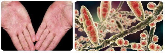 Ламизил крем гъбички 02