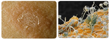 Ламизил крем гъбички 03