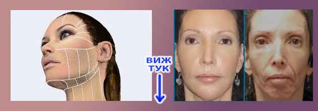 Hifu Lifting Mnenia 02