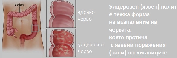 Салофалк Демир бозан колит черва 01