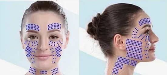 Хайфу лифтинг за кожа лице шия деколте 01