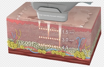 Хайфу лифтинг за кожа лице шия деколте 01