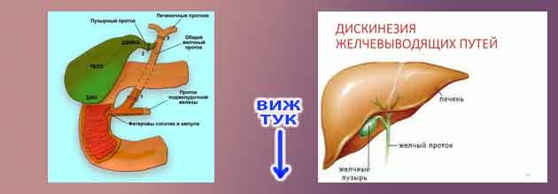 Може ли да се оправи прегъната жлъчка (билиарна дискинезия)? 4 Може ли да се оправи прегъната жлъчка 4