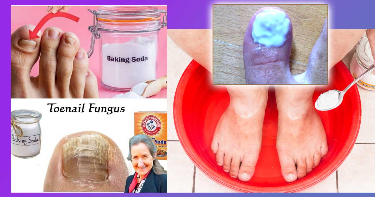 Сода бикарбонат за гъбички по ноктите | 10+ рецепти 13 Как се ползва сода бикарбонат за гъбички по ноктите. Добавки и вариации със сол, оцет, мед, лимон. Пиене на сода против гъбички. Как се отървах от гъбички по ноктите с лак и лек, лекарства.