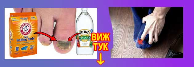 сода бикарбонат гъбички по ноктите 2