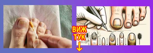 сода бикарбонат гъбички по ноктите 4