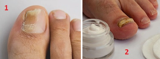 Сода бикарбонат гъбички по ноктите 01