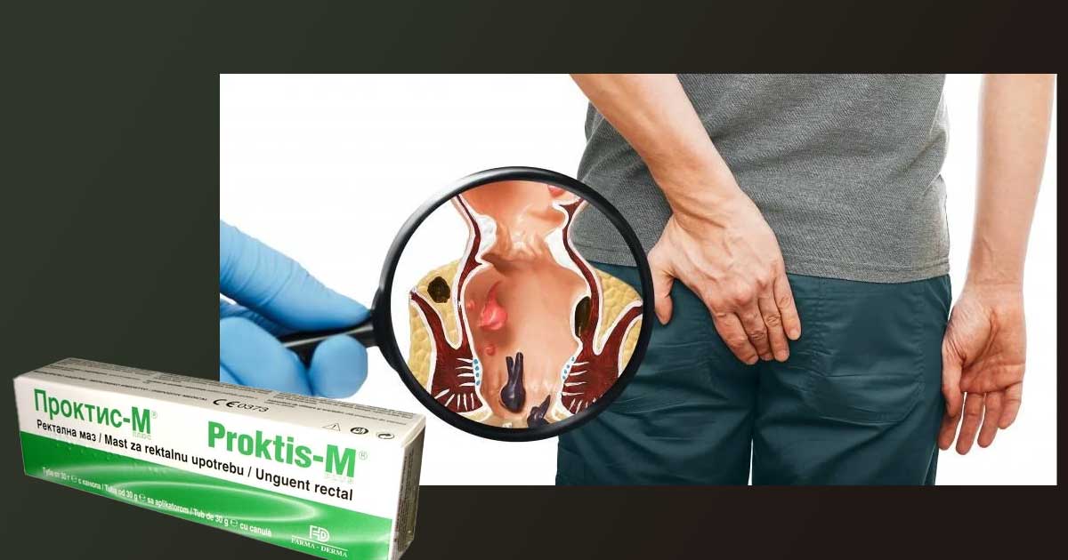 Проктис М: Мнения за ректална маз и свещички за хемороиди 16 Мнения за Проктис М, ректална маз за хемороиди от БГ Мама и др. Използване на свещички и таблетки. Заместители: Хеморрел, Флебодия, Детралекс, Цикатридина, ПроктоГливенол, Долопрокт.